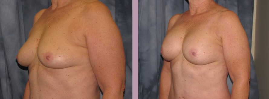 Case--872 | Before and After Mommy Makeover 8