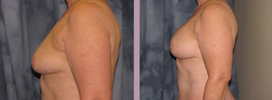 Case--872 | Before and After Mommy Makeover 9