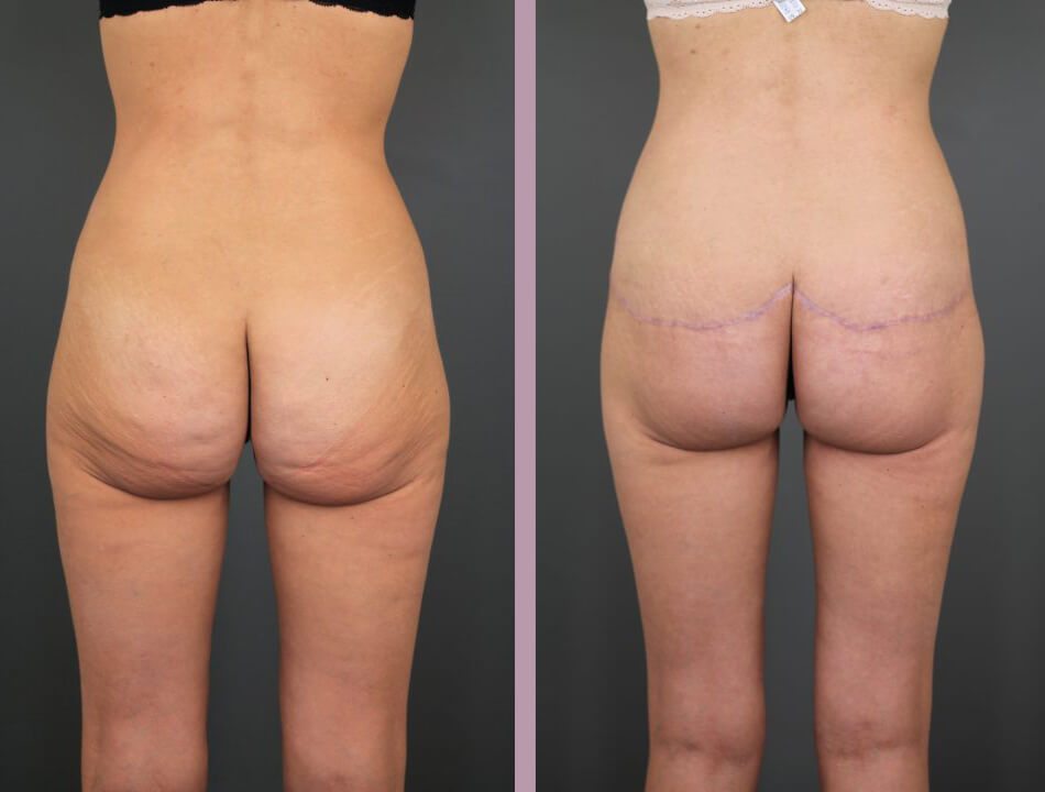 Case--16423 | Before and After Posterior Belt Lipectomy