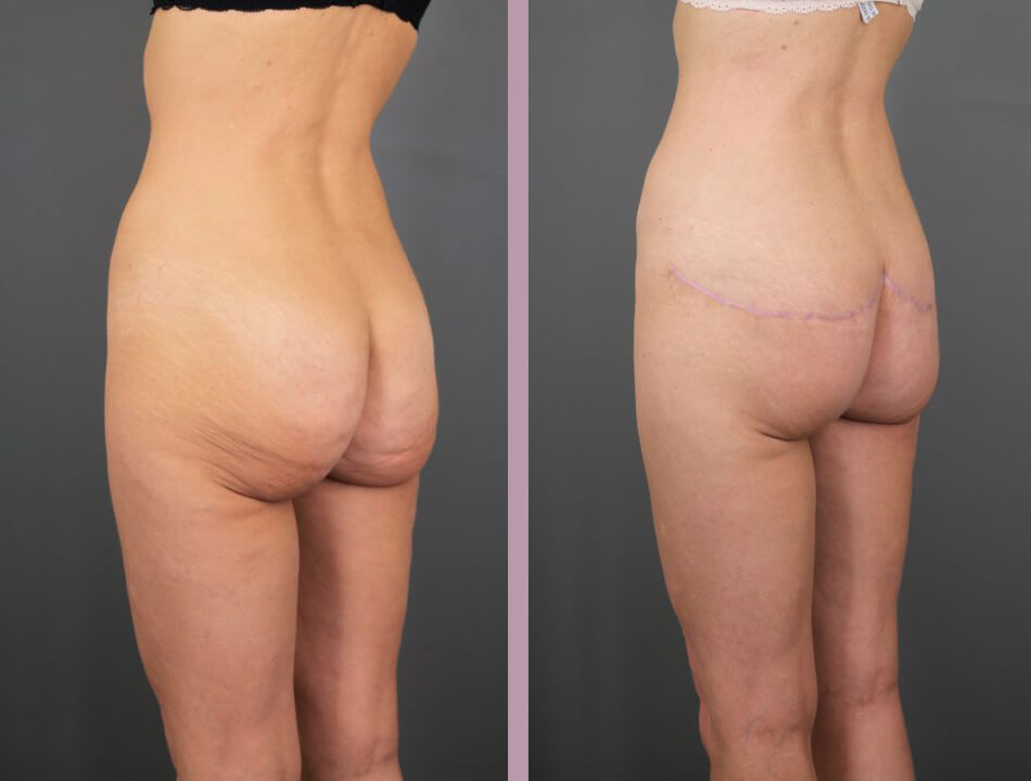 Case--16423 | Before and After Posterior Belt Lipectomy 2