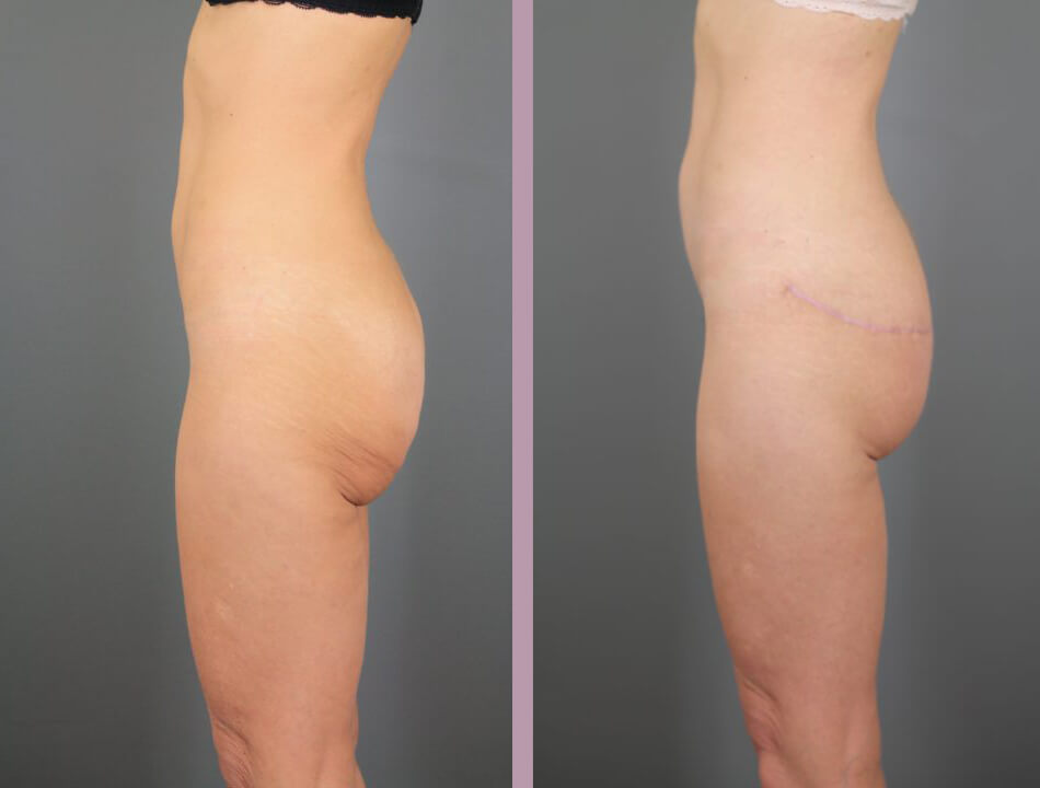 Case--16423 | Before and After Posterior Belt Lipectomy 3