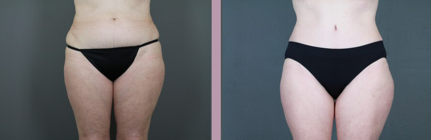 Case--14998 | Before and After Tummy Tuck