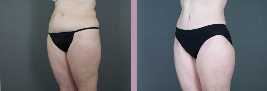 Case--14998 | Before and After Tummy Tuck 2