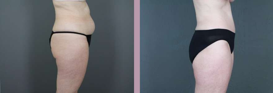 Case--14998 | Before and After Tummy Tuck 3