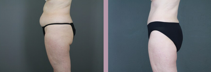 Case--14998 | Before and After Tummy Tuck 4