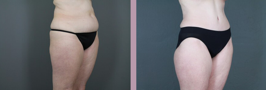 Case--14998 | Before and After Tummy Tuck 5