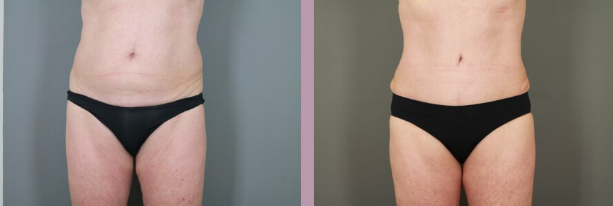 Case--15058 | Before and After Tummy Tuck