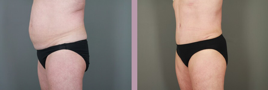 Case--15058 | Before and After Tummy Tuck 2