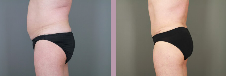 Case--15058 | Before and After Tummy Tuck 3