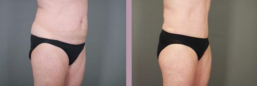 Case--15058 | Before and After Tummy Tuck 4