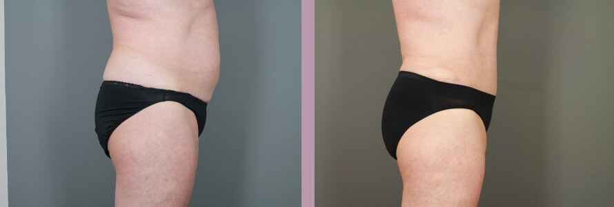 Case--15058 | Before and After Tummy Tuck 5