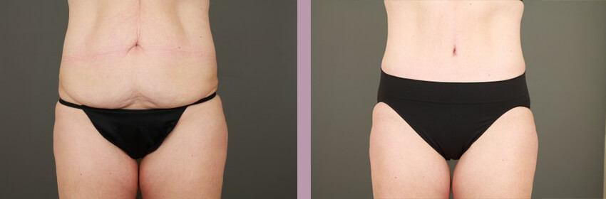 Case--15248 | Before and After Tummy Tuck