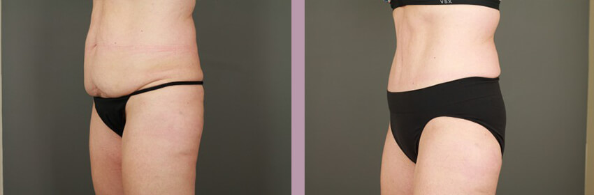 Case--15248 | Before and After Tummy Tuck 2