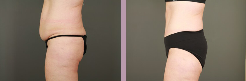 Case--15248 | Before and After Tummy Tuck 3