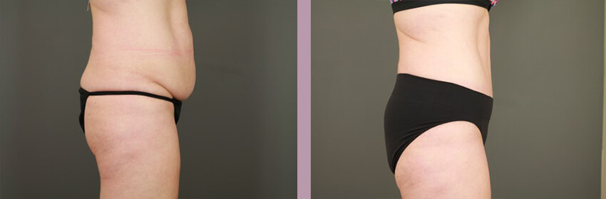 Case--15248 | Before and After Tummy Tuck 4