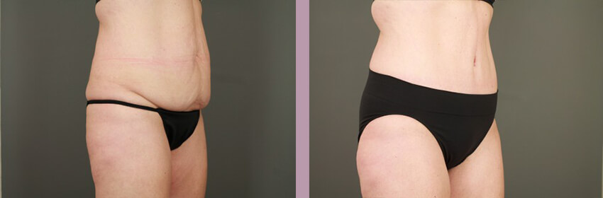 Case--15248 | Before and After Tummy Tuck 5