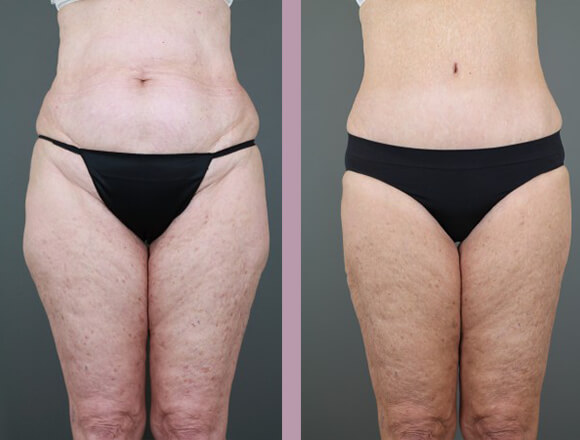 Case--15334 | Before and After Tummy Tuck