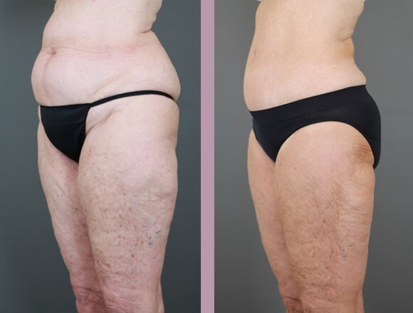 Case--15334 | Before and After Tummy Tuck 2