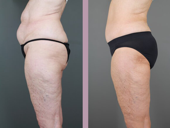 Case--15334 | Before and After Tummy Tuck 3