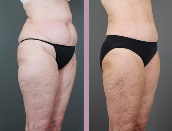 Case--15334 | Before and After Tummy Tuck 4