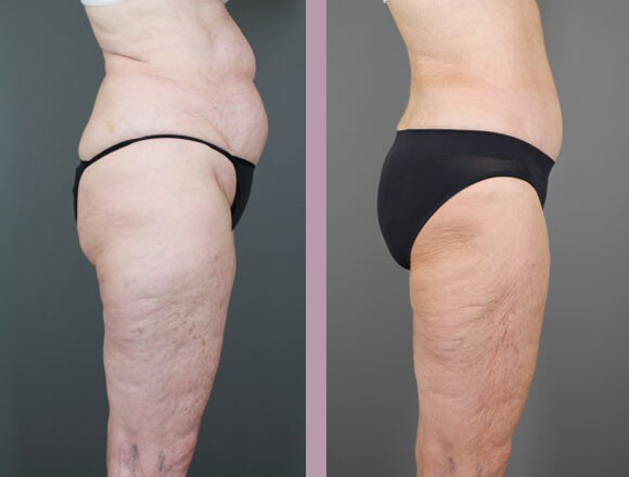 Case--15334 | Before and After Tummy Tuck 5