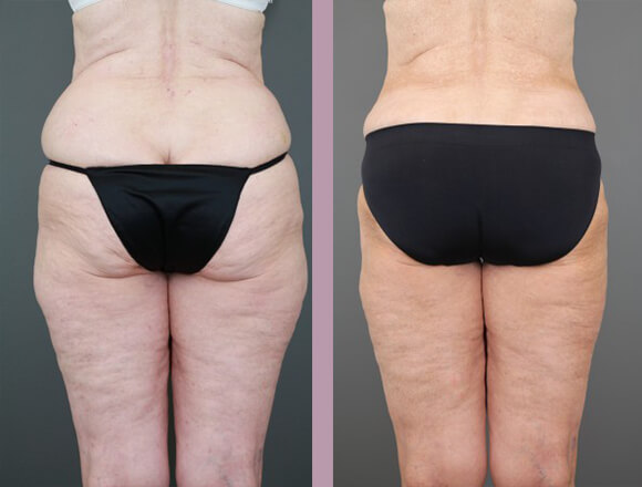 Case--15334 | Before and After Tummy Tuck 6