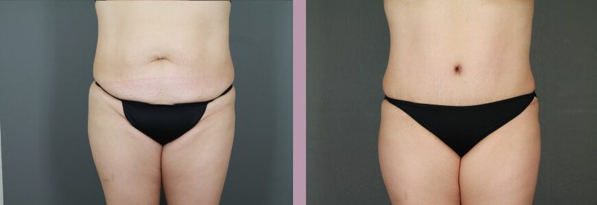Case--15367 | Before and After Tummy Tuck