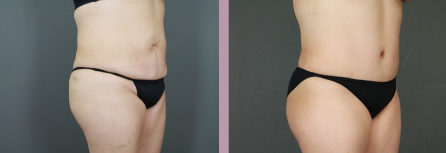 Case--15367 | Before and After Tummy Tuck 2