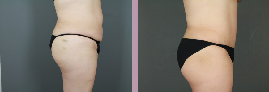 Case--15367 | Before and After Tummy Tuck 3