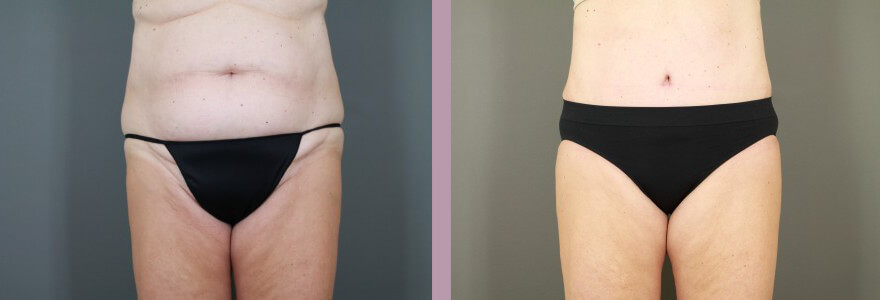 Case--15449 | Before and After Tummy Tuck