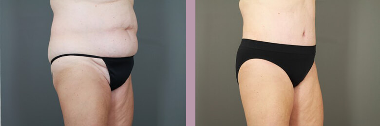 Case--15449 | Before and After Tummy Tuck 5