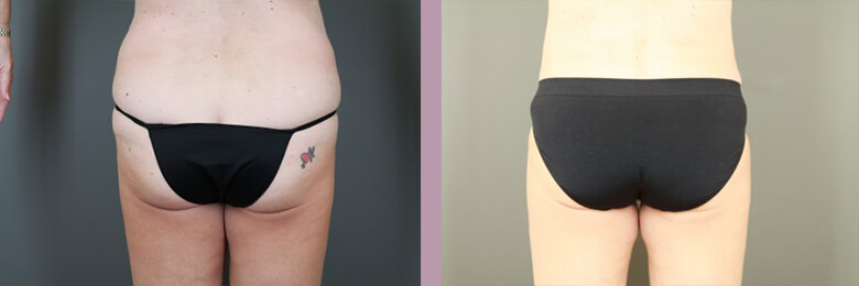 Case--15449 | Before and After Tummy Tuck 6