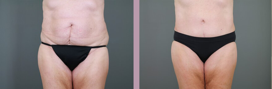 Case--15521 | Before and After Tummy Tuck