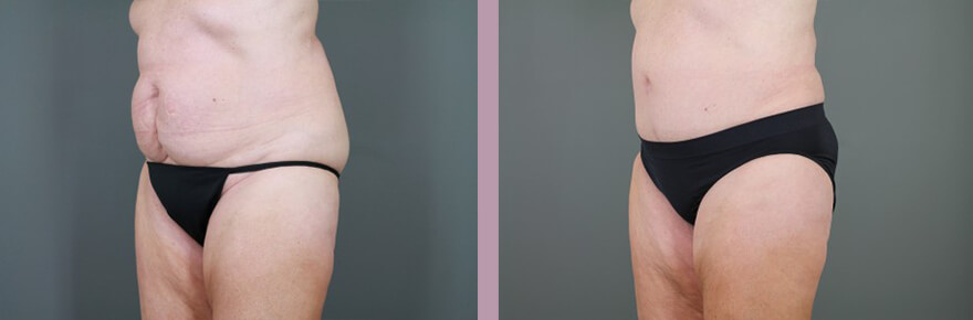 Case--15521 | Before and After Tummy Tuck 2