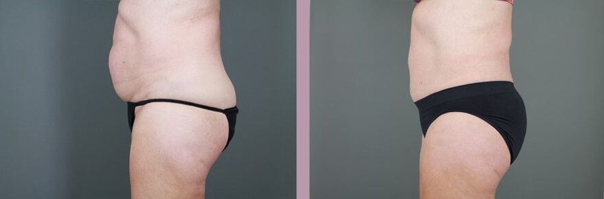 Case--15521 | Before and After Tummy Tuck 3