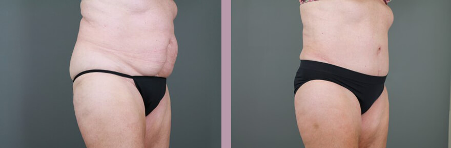 Case--15521 | Before and After Tummy Tuck 4