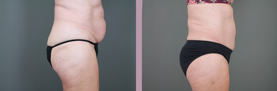 Case--15521 | Before and After Tummy Tuck 5