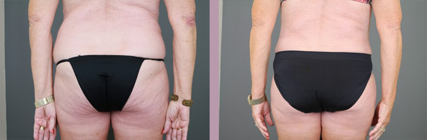 Case--15521 | Before and After Tummy Tuck 6