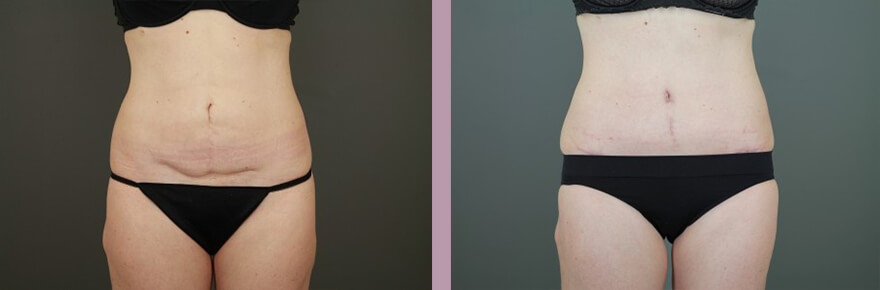 Case--15632 | Before and After Tummy Tuck