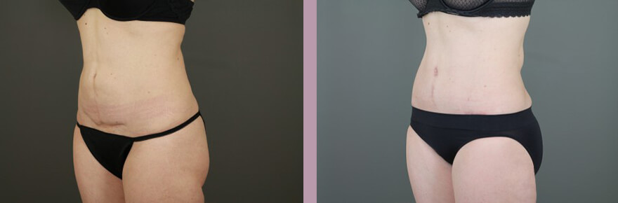 Case--15632 | Before and After Tummy Tuck 2