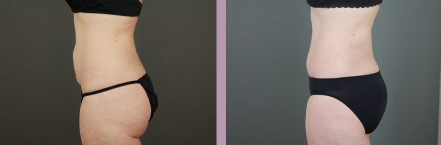 Case--15632 | Before and After Tummy Tuck 3