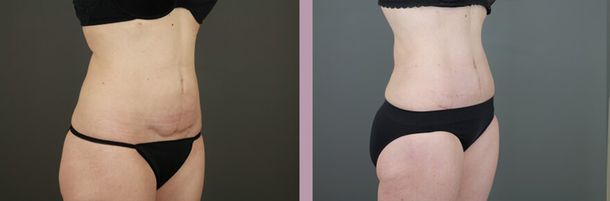 Case--15632 | Before and After Tummy Tuck 4