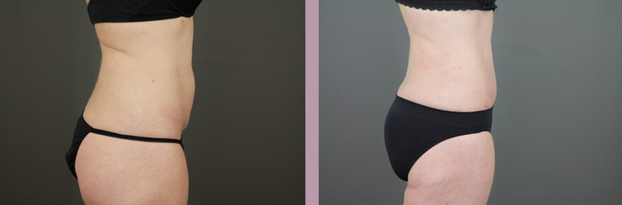 Case--15632 | Before and After Tummy Tuck 5
