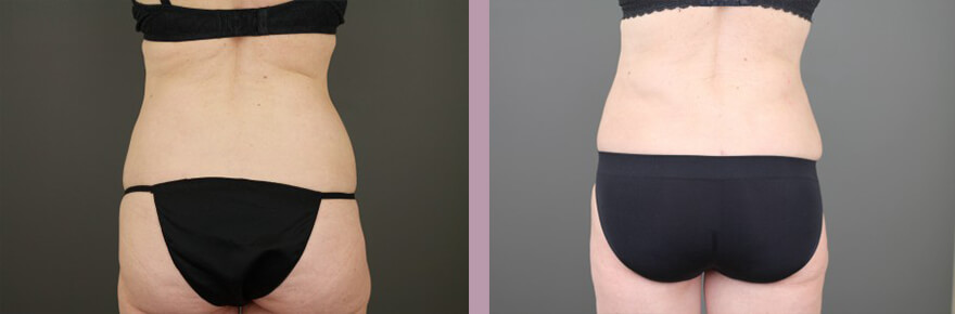 Case--15632 | Before and After Tummy Tuck 6