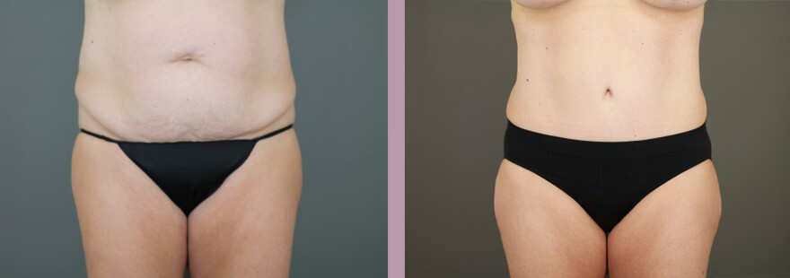 Case--15896 | Before and After Tummy Tuck