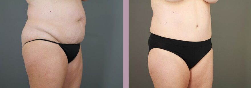 Case--15896 | Before and After Tummy Tuck 2