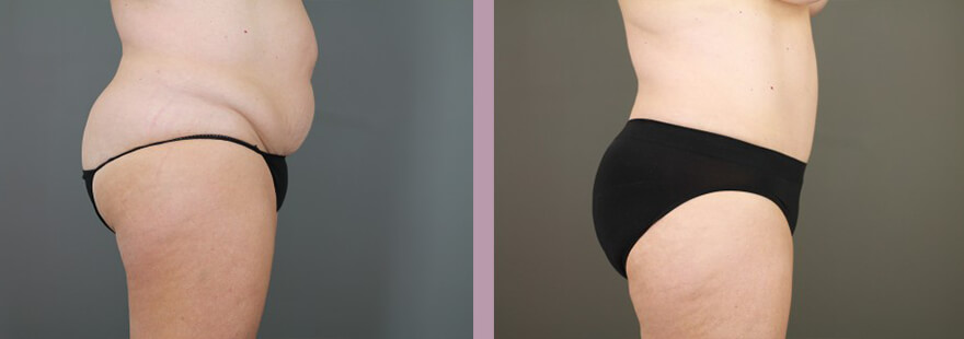 Case--15896 | Before and After Tummy Tuck 3