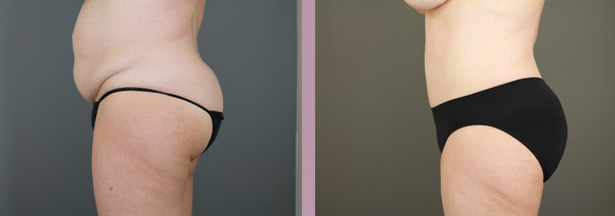 Case--15896 | Before and After Tummy Tuck 4