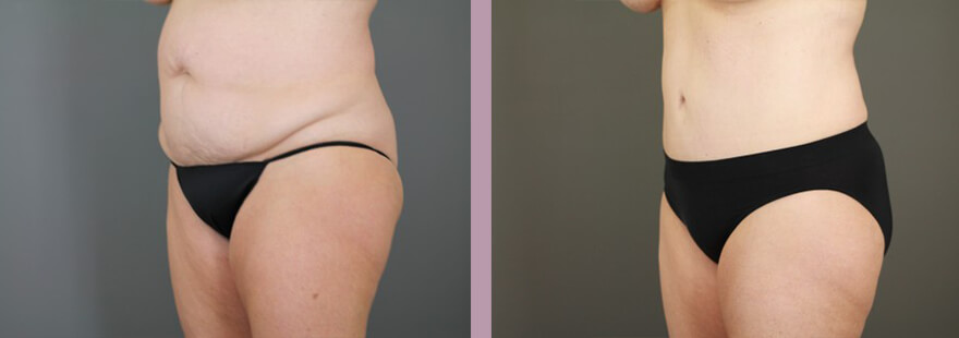 Case--15896 | Before and After Tummy Tuck 5