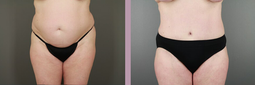 Case--15950 | Before and After Tummy Tuck